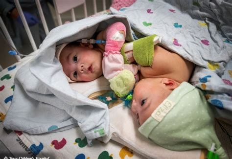 ella and eliza conjoined twins|conjoined twins separation surgery.